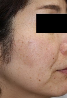 lasertreatment4