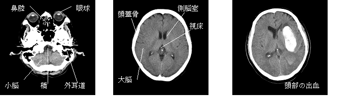 写真　頭部CT画像