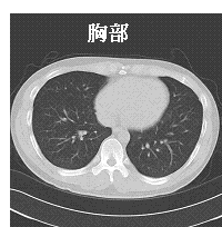 写真　胸部CT画像