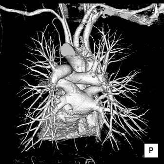 写真　肺血管3D画像